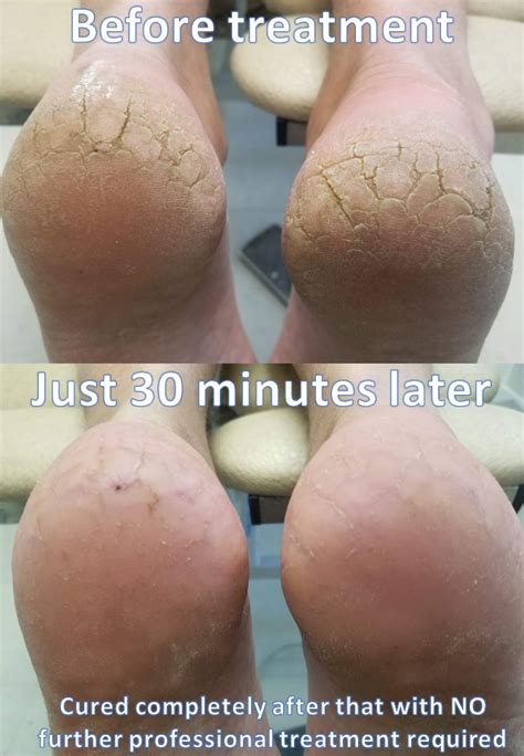 Share More Than Cracked Heel Treatment Uk Best Esthdonghoadian