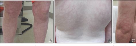 Amantadine Induced Livedo Reticularis In A Child Treated Off Label For