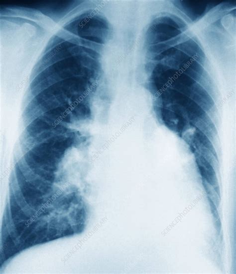 How do health care professionals determine throat cancer staging? Throat cancer, X-ray - Stock Image - M134/0485 - Science ...