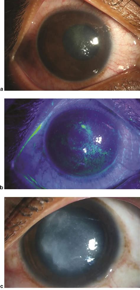 Early Signs Of Acanthamoeba Keratitis American Academy Of Ophthalmology