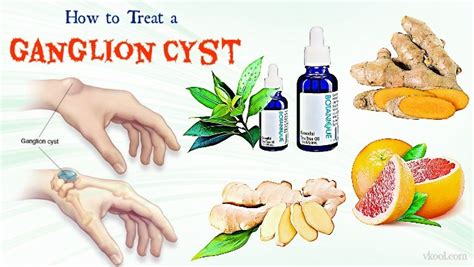 Ways On How To Treat A Ganglion Cyst Naturally At Home