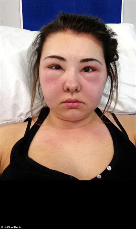 Sales Coordinator Blinded After Allergic Reaction To Hair Dye Daily