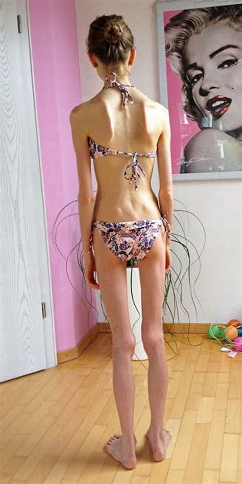 spočiatku Pripojiť k upokojiť anorexic bikini alergický výlet podávanie
