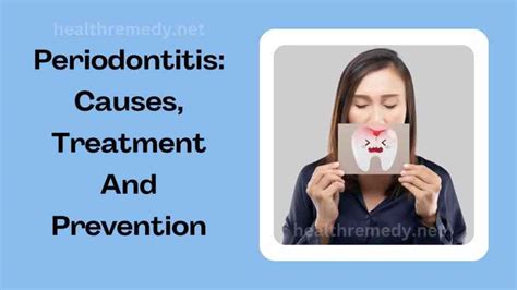 Periodontitis Causes Treatment And Prevention