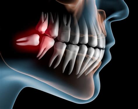 What Age Does Wisdom Teeth Come In Boston Dentist Congress Dental