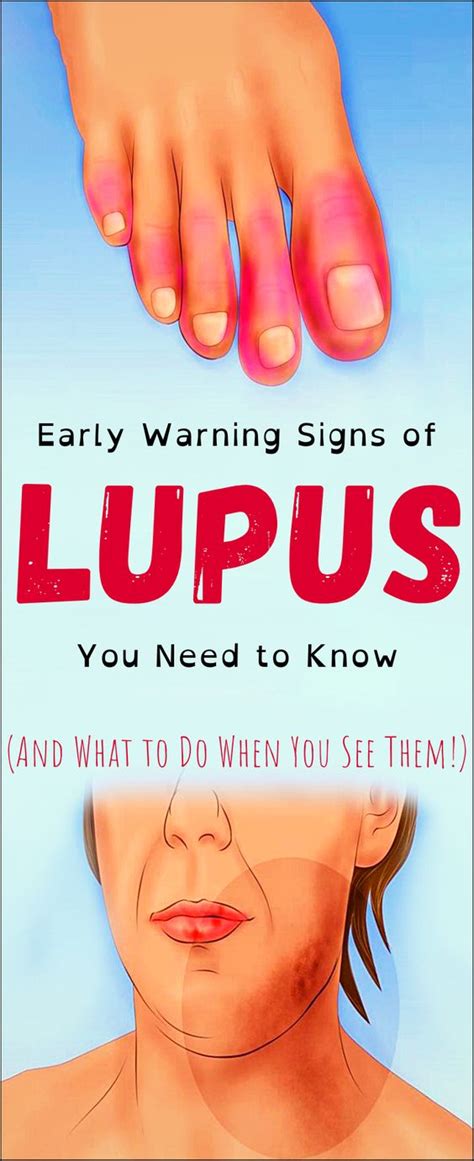 Early Warning Signs Of Lupus You Need To Know And What To Do The Moment You See Them