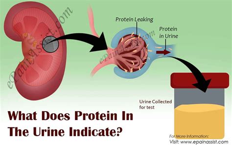 What Does Leaking Kidneys Mean