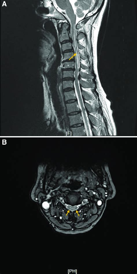 The Cervical Spine Magnetic Resonance Imaging A A T2 Weighted Image