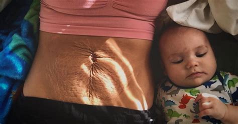 Postpartum Body Viral Photo Stretch Marks