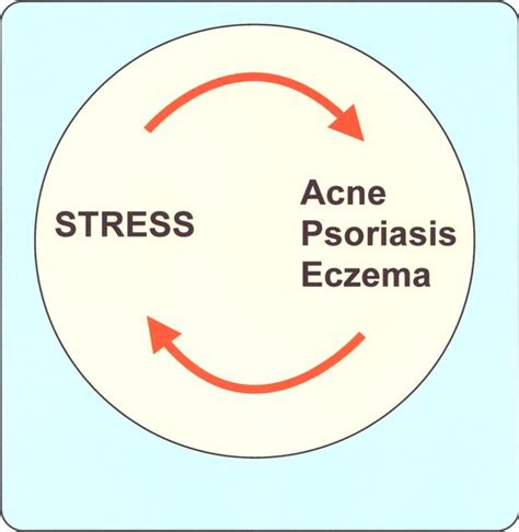 Stress And Atopic Eczema Atopic Skin Disease