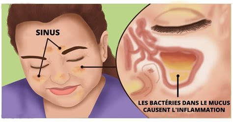 7 Façons Très Simples De Prévenir Linfection Des Sinus Infection Des