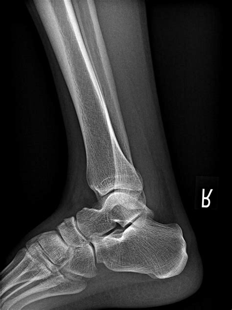 Navicular Bone Fracture On The X Ray Trauma From Falling Of A Scooter
