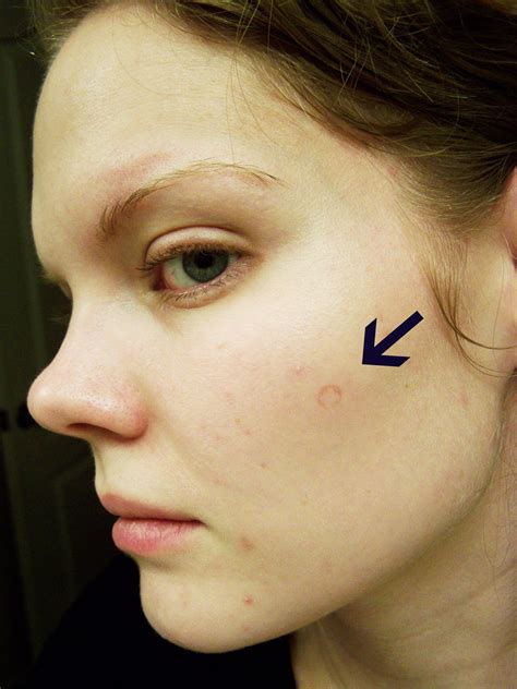 Ringworm On Cheek Pictures Photos