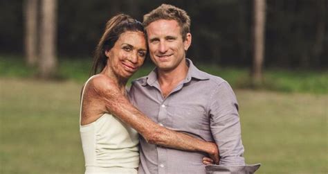 Turia Pitt S Story Her Recovery From Burns Thenetline