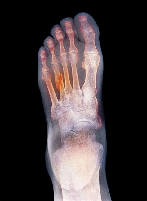 Fractured Foot X Ray Photograph By Du Cane Medical Imaging Ltd Pixels