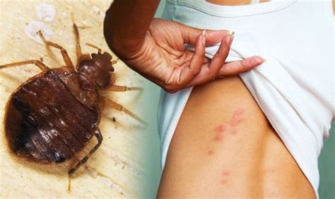 What causes bed bugs to proliferate are dark, safe places they can live undisturbed. Bed bug bites: Infestation causes red lumps - bite ...