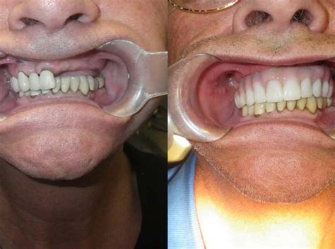 Before After Dental Implants Vacations