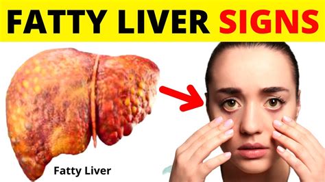 Extra In Fatty Liver Liver Disease Symptoms Fatty Liver Disease My Xxx Hot Girl