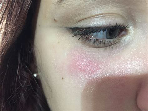 Allergic Reaction To Makeup On Eyelids Saubhaya Makeup