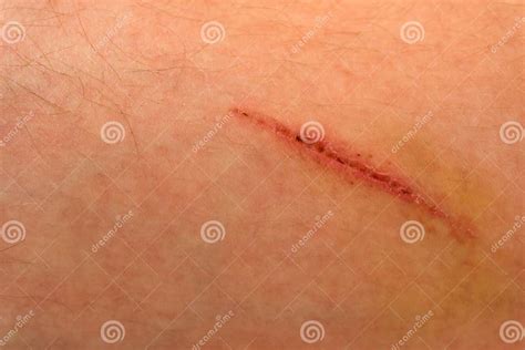 A Wound On The Human Body Suture Old Deep Cut Scar Close Up