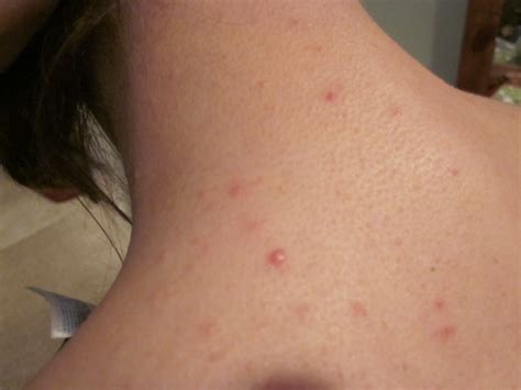 Pimple Like Bumps On Back Submited Images