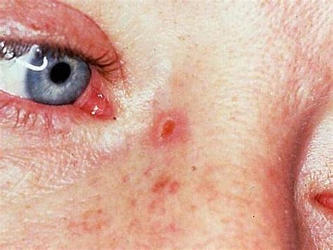 Basal Cell Carcinoma On The Nose Skin Cancer Or Mole How To Tell Pictures Cbs News