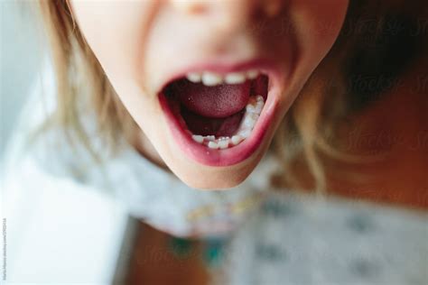 Closeup Of Little Kid With Extra Teeth In Mouth By Stocksy