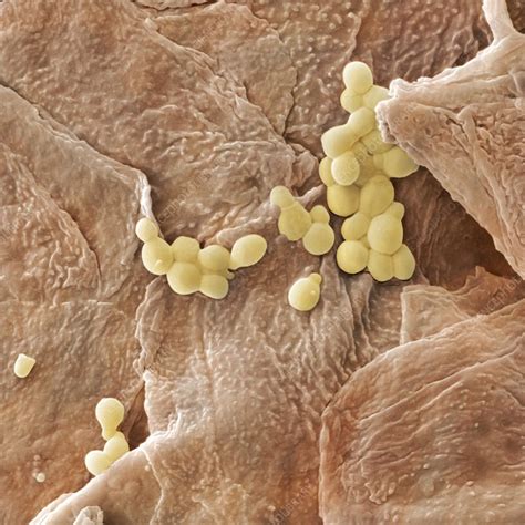 Yeast Fungus Skin Infection Sem Stock Image C0105219 Science