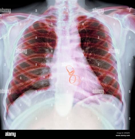 Prosthetic Heart Valves X Ray Stock Photo Alamy