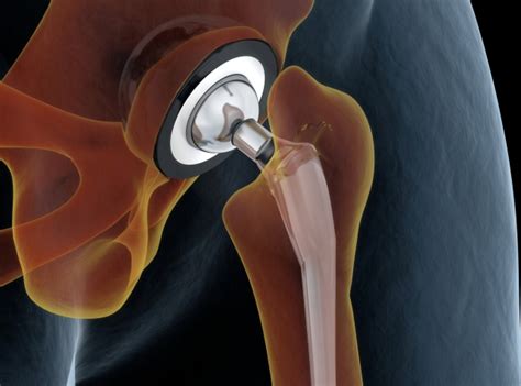 Bioengineers Use Artificial Intelligence To Transform Hip Surgery Healthtimes