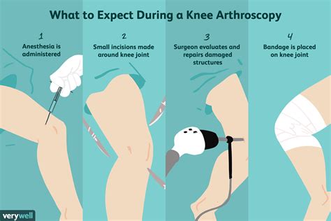 Some people confuse the words leg and lower extremity, but in anatomic terms the leg spans only the distance from the knee to the ankle. Arthroscopic Knee Surgery Side Effects - Images Of The ...