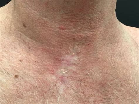 Mohs Surgery Scar Healing Via Laser Topical And Injection Tx