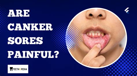 27 Canker Sore Treatments That You Will Actually Want To Try Teethopedia