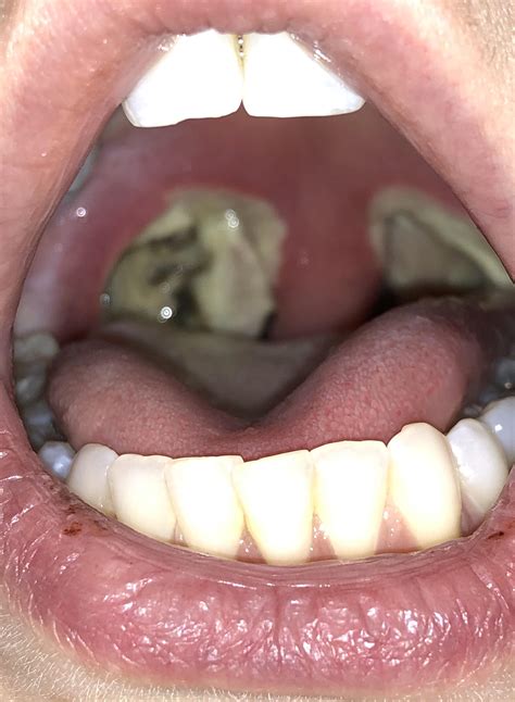 Tonsillectomy Scabs Falling Off