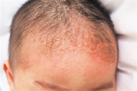 What Is Seborrheic Dermatitis Symptoms And Treatments Facty Health