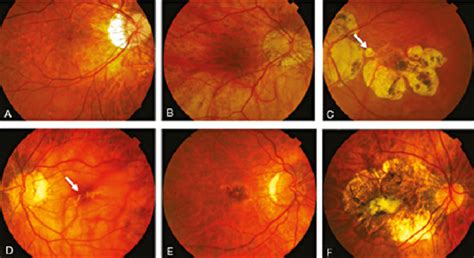 Color Fundus Photographs Representing Different Types Of Myopic