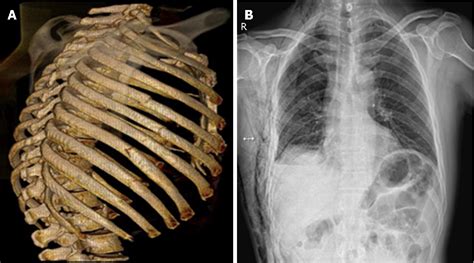 Figure 1 From Surgical Treatment Ofpatients With Severe Non Flail Chest