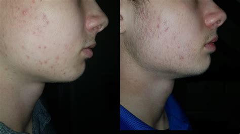 Best Technique To Prevent And Treat Beard Acne Beard And Acne