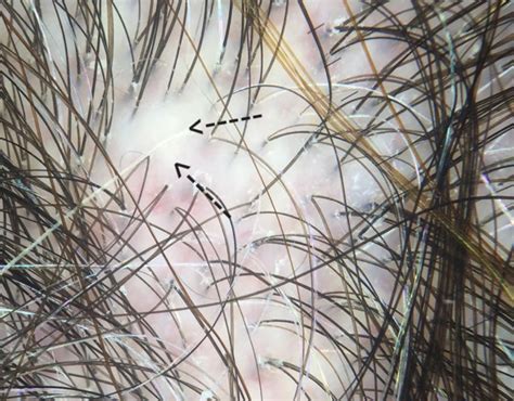 Scarring Alopecia Loss Of The Follicular Opening Is A Hallmark
