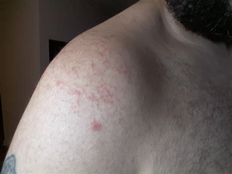 Is This Eczema Or Some Type Of Other Rash Image Accutane
