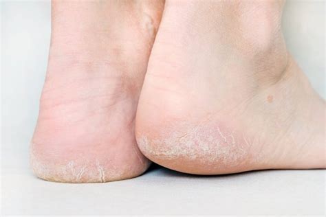 why are my feet peeling top 5 causes tua saúde