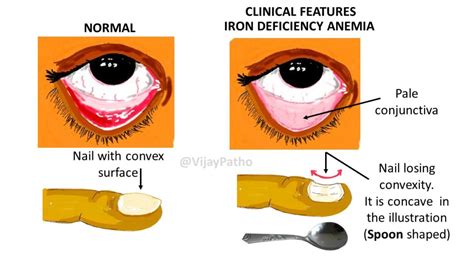 Pathology Of Iron Deficiency Anemia Pathology Made Simple