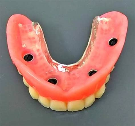 Locator Implant Retained Dentures Burnham Denture Clinic In Edmonton