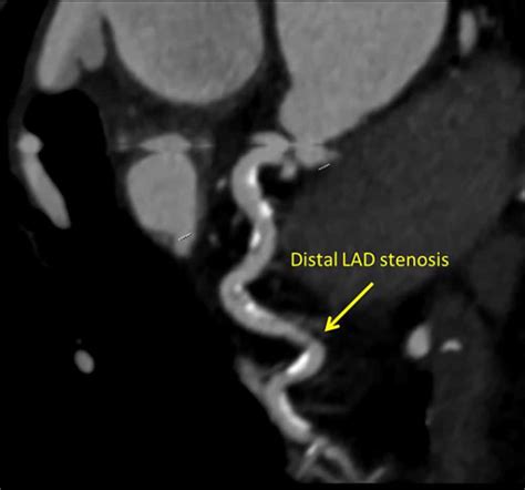 Coronary Artery Angiography Wfsa Resources