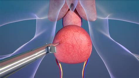 Higher Facility Associated With Longer Survival After Prostatectomy