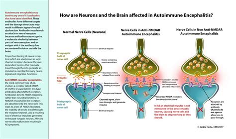 How Is The Brain Affected In Autoimmune Encephalitis Jackie Heda