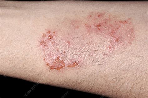 Ringworm Fungal Infection Stock Image C040 1393 Science Photo Library