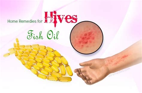Top 16 Natural Home Remedies For Hives On Face And Body
