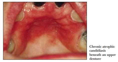 Pdf Swellings And Red White And Pigmented Lesions Ovi Dental