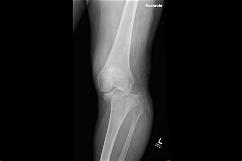 Ortho Dx Left Knee Pain And Deformity Following A Fall Clinical Advisor